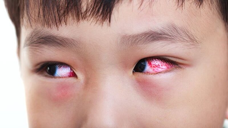 Đau mắt đỏ tăng nguy cơ bị loạn thị