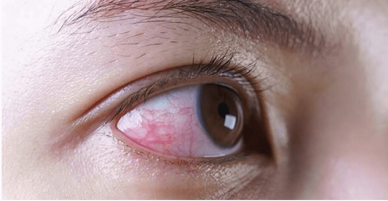 Đeo lens bị cay mắt