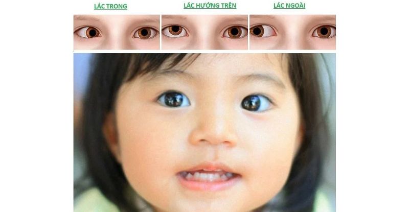 Cách phát hiện lác ở trẻ viễn thị là bước đầu tiên giúp cha mẹ nhận diện các dấu hiệu lác mắt và điều trị sớm