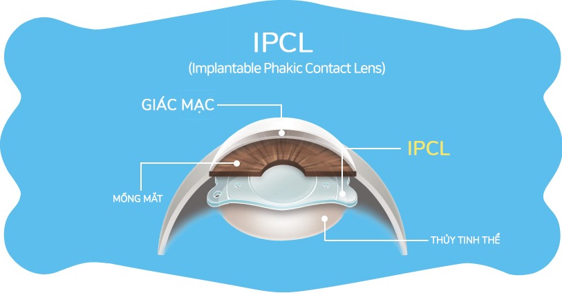 Quy trình mổ mắt phakic