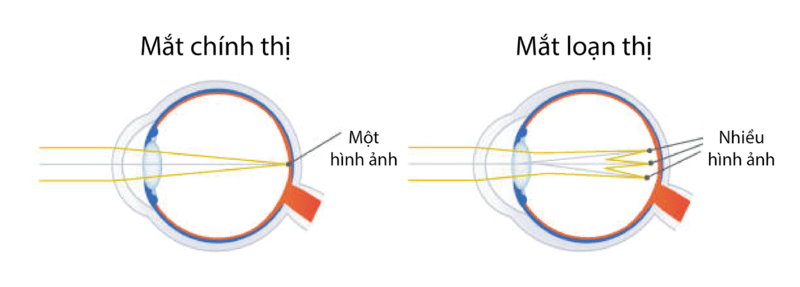 Dấu hiệu cảnh báo nhược thị