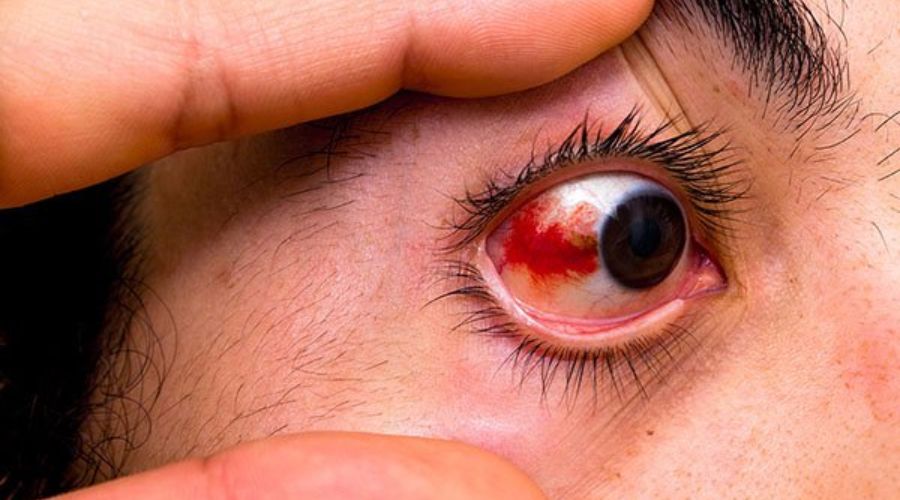 Biểu hiện của đau mắt đỏ sau mổ loạn