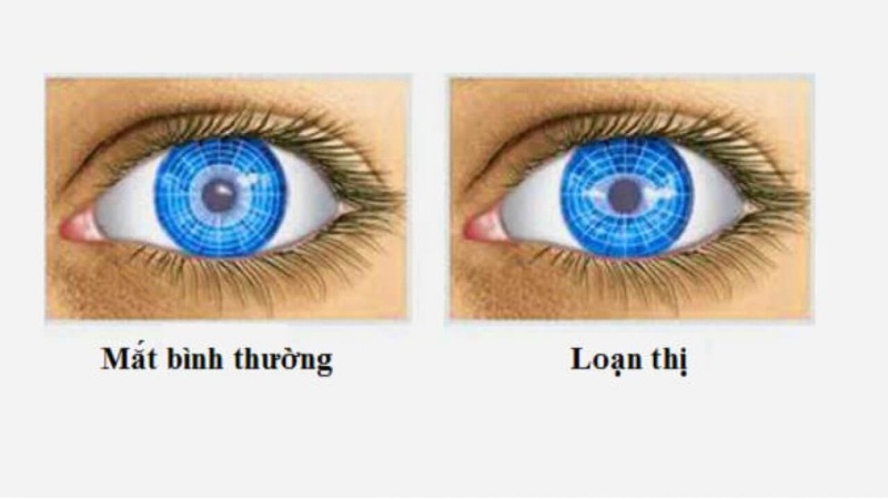 Mắt loạn thị