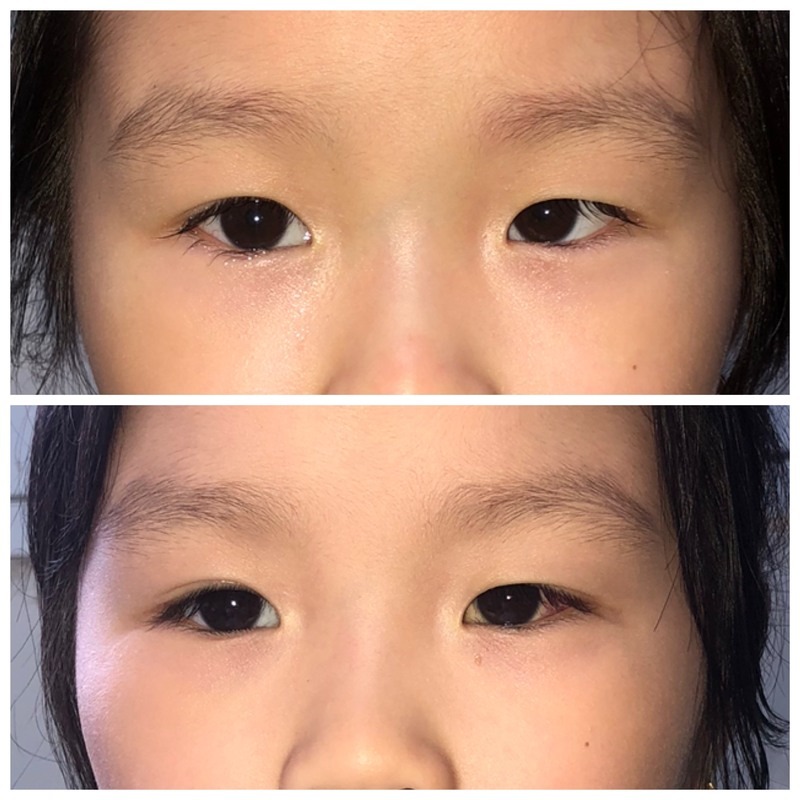 Nhược thị lác mắt