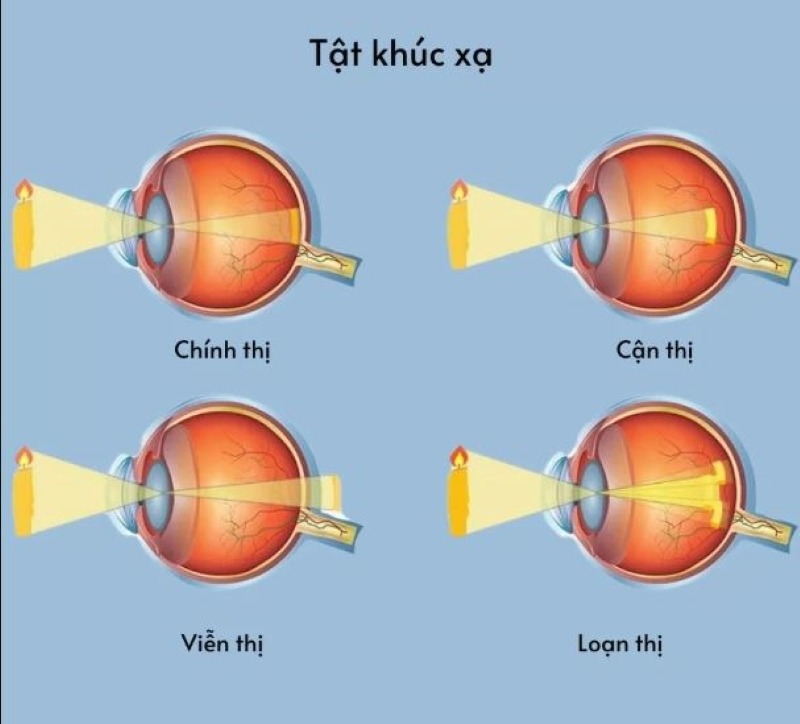 Hiểu về tật khúc xạ - viễn - nhược thị