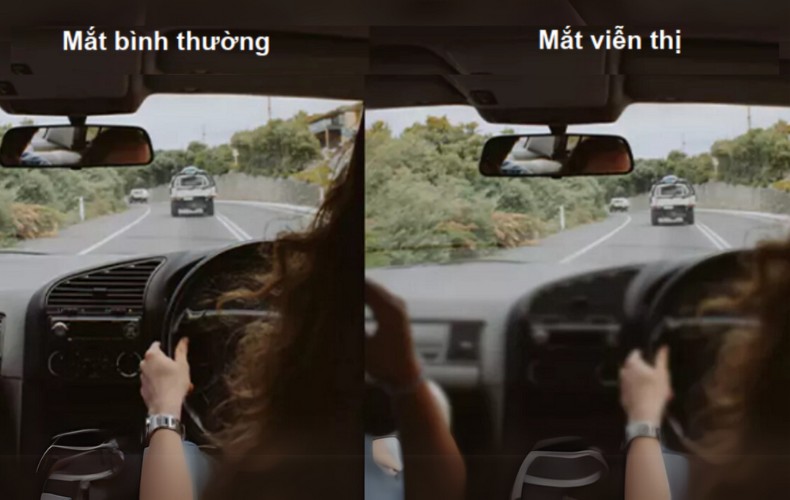 Nhìn mờ khi quan sát các vật ở gần là biểu hiện của viễn thị 2 độ
