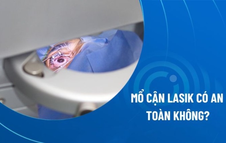 Phẫu thuật Lasik có an toàn không?