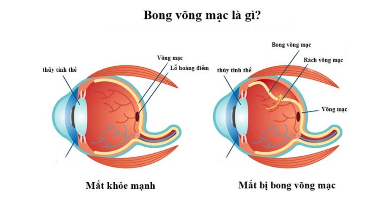 Biến chứng bong võng mạc trên mắt cận thị