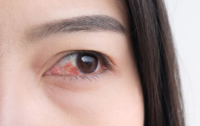 Mắt bị đỏ 1 bên nhưng không đau có phải là dấu hiệu nguy hiểm không?