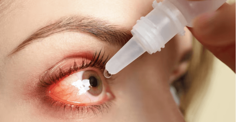 Thuốc nhỏ mắt đau mắt đỏ
