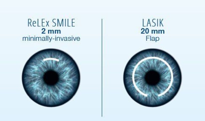 So sánh mổ Femto và Smile