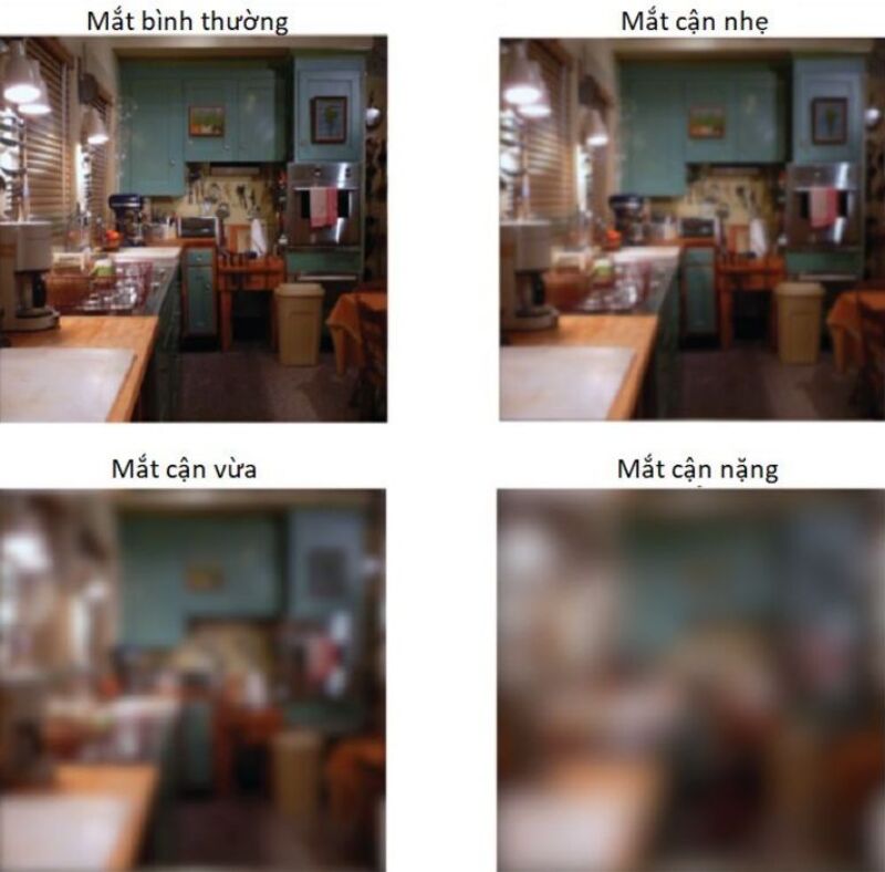 Cận nhẹ là tình trạng khúc xạ khi độ cận của mắt dưới 3 độ