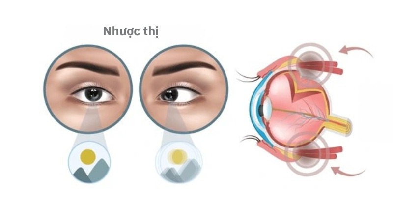 Hình ảnh mắt bị nhược thị