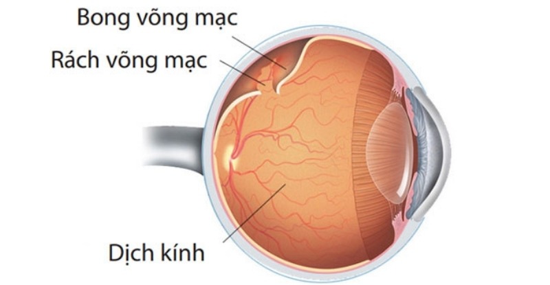 Mắt cận thị có thể gây bong rách võng mạc